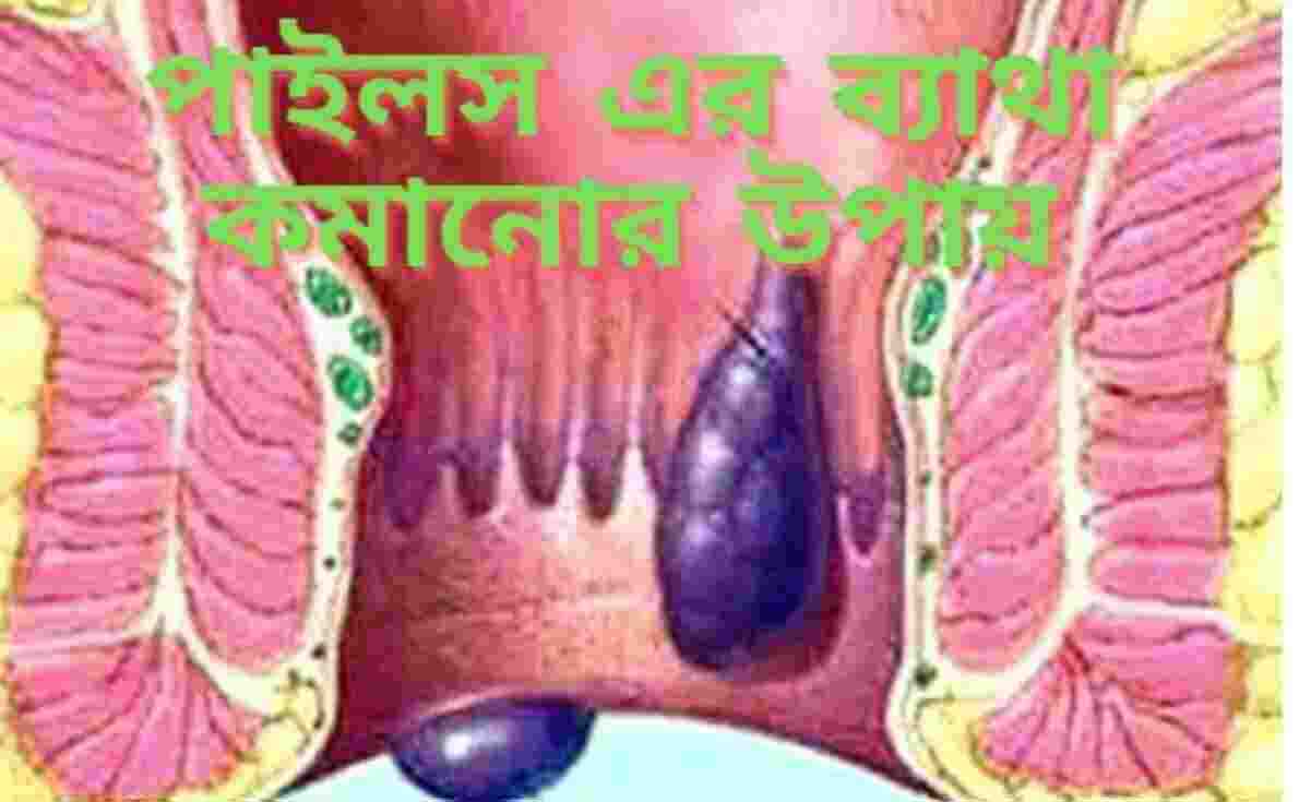 পাইলস এর ব্যাথা কমানোর উপায়