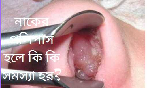 নাকের পলিপাস হলে কি কি সমস্যা হয়